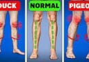 Comparison of outward, neutral, and inward foot alignment